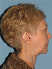 Chin Augmentation After Photo by Paul Vanek, MD, FACS; Concord, OH - Case 32772