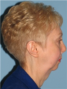 Chin Augmentation Before Photo by Paul Vanek, MD, FACS; Concord, OH - Case 32772