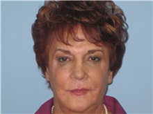 Dermal Fillers After Photo by Paul Vanek, MD, FACS; Concord, OH - Case 32797