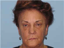 Dermal Fillers Before Photo by Paul Vanek, MD, FACS; Concord, OH - Case 32797