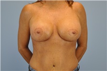 Breast Reconstruction After Photo by Paul Vanek, MD, FACS; Concord, OH - Case 32799