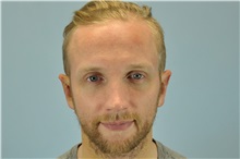 Ear Surgery After Photo by Paul Vanek, MD, FACS; Concord, OH - Case 32801