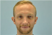 Ear Surgery Before Photo by Paul Vanek, MD, FACS; Concord, OH - Case 32801