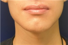 Chin Augmentation After Photo by Richard Reish, MD, FACS; New York, NY - Case 32838