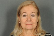 Eyelid Surgery After Photo by Ellen Janetzke, MD; Bloomfield Hills, MI - Case 33143