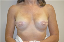 Breast Reconstruction After Photo by Joe Griffin, MD; Florence, SC - Case 33177