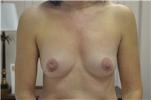 Breast Reconstruction Before Photo by Joe Griffin, MD; Florence, SC - Case 33177