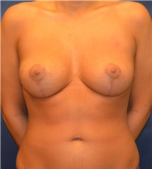 Breast Lift After Photo by Matthew Kilgo, MD, FACS; Garden City, NY - Case 33212
