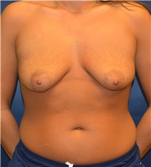 Breast Lift Before Photo by Matthew Kilgo, MD, FACS; Garden City, NY - Case 33212