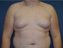 Male Breast Reduction Before Photo by Matthew Kilgo, MD, FACS; Garden City, NY - Case 33217