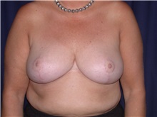 Breast Reduction After Photo by Gary Culbertson, MD, FACS; Sumter, SC - Case 33342