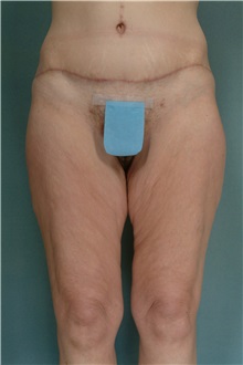 Body Lift After Photo by Robert Zubowski, MD; Paramus, NJ - Case 33358