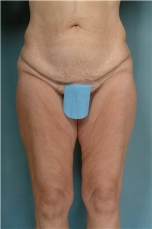 Body Lift Before Photo by Robert Zubowski, MD; Paramus, NJ - Case 33358