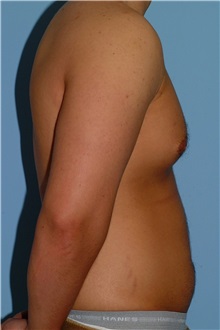 Male Breast Reduction Before Photo by Paul Vanek, MD, FACS; Concord, OH - Case 34036
