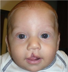 Cleft Lip and Palate Repair Before Photo by Rachel Ruotolo, MD; Garden City, NY - Case 34079