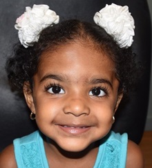 Craniosynostosis After Photo by Rachel Ruotolo, MD; Garden City, NY - Case 34083