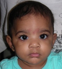 Craniosynostosis Before Photo by Rachel Ruotolo, MD; Garden City, NY - Case 34083