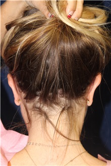 Ear Surgery After Photo by Scott Miller, MD; La Jolla, CA - Case 34183