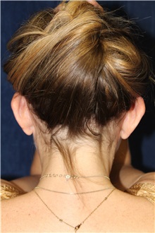 Ear Surgery Before Photo by Scott Miller, MD; La Jolla, CA - Case 34183