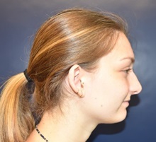 Ear Surgery Before Photo by Rachel Ruotolo, MD; Garden City, NY - Case 34204