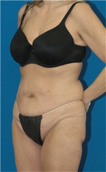 Body Lift Before Photo by Scott Sattler, MD,  FACS; Seattle, WA - Case 34340