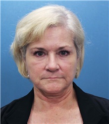 Facelift Before Photo by Marvin Shienbaum, MD; Brandon, FL - Case 34975