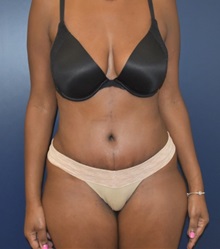 Liposuction After Photo by Richard Reish, MD, FACS; New York, NY - Case 35290