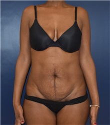 Liposuction Before Photo by Richard Reish, MD, FACS; New York, NY - Case 35290