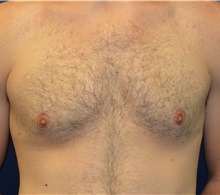 Male Breast Reduction After Photo by Matthew Kilgo, MD, FACS; Garden City, NY - Case 35314