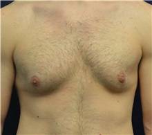 Male Breast Reduction Before Photo by Matthew Kilgo, MD, FACS; Garden City, NY - Case 35314