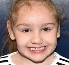 Cleft Lip and Palate Repair After Photo by Rachel Ruotolo, MD; Garden City, NY - Case 35505