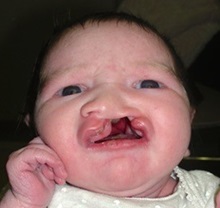 Cleft Lip and Palate Repair Before Photo by Rachel Ruotolo, MD; Garden City, NY - Case 35505