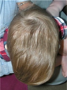 Craniosynostosis After Photo by Rachel Ruotolo, MD; Garden City, NY - Case 35506