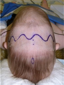 Craniosynostosis Before Photo by Rachel Ruotolo, MD; Garden City, NY - Case 35506