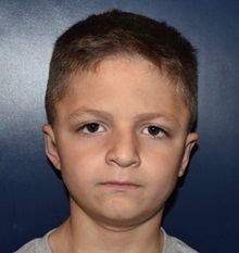 Ear Surgery After Photo by Rachel Ruotolo, MD; Garden City, NY - Case 35585