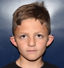 Ear Surgery Before Photo by Rachel Ruotolo, MD; Garden City, NY - Case 35585