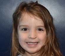 Cleft Lip and Palate Repair After Photo by Rachel Ruotolo, MD; Garden City, NY - Case 35586