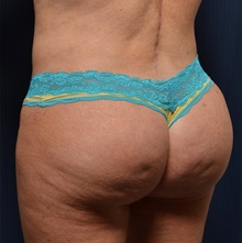 Buttock Lift with Augmentation After Photo by Michael Frederick, MD; Fort Lauderdale, FL - Case 35874