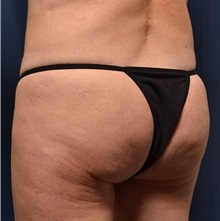 Buttock Lift with Augmentation Before Photo by Michael Frederick, MD; Fort Lauderdale, FL - Case 35874