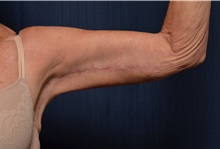 Arm Lift After Photo by Michael Frederick, MD; Fort Lauderdale, FL - Case 35883
