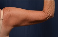 Arm Lift After Photo by Michael Frederick, MD; Fort Lauderdale, FL - Case 35883