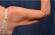 Arm Lift Before Photo by Michael Frederick, MD; Fort Lauderdale, FL - Case 35883