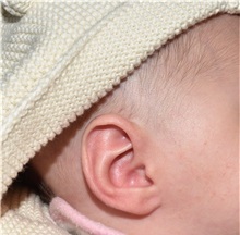 Ear Surgery After Photo by Rachel Ruotolo, MD; Garden City, NY - Case 36062