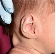 Ear Surgery Before Photo by Rachel Ruotolo, MD; Garden City, NY - Case 36062