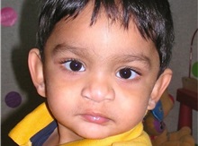 Cleft Lip and Palate Repair After Photo by Rachel Ruotolo, MD; Garden City, NY - Case 36163