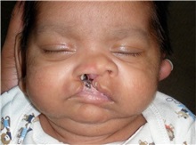Cleft Lip and Palate Repair Before Photo by Rachel Ruotolo, MD; Garden City, NY - Case 36163