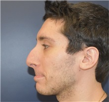 Rhinoplasty Before Photo by Richard Reish, MD, FACS; New York, NY - Case 36265