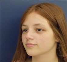 Rhinoplasty After Photo by Richard Reish, MD, FACS; New York, NY - Case 36312