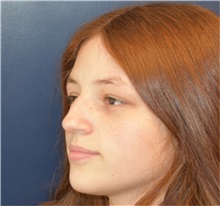 Rhinoplasty Before Photo by Richard Reish, MD, FACS; New York, NY - Case 36312
