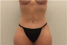 Tummy Tuck After Photo by Ravi Somayazula, DO; Houston, TX - Case 36626
